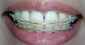 歯列矯正 変化の様子を写真で見てみようブログ 22回目の調整 11年4月5日