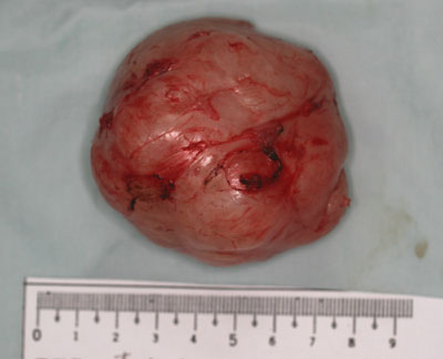 骨盤腔内腫瘍2